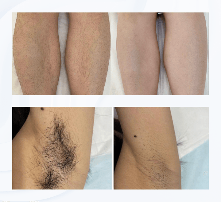 Before and after results of Diode Laser 808+1064+755+940nm Hair Removal Machine, showing visible hair reduction and smoother skin